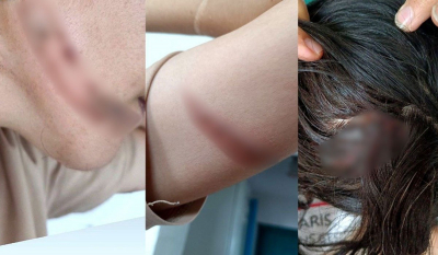 &laquo;Периодически избивает&raquo;: жительница Семея показала страшные травмы, нанесенные мужем