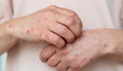 Корь выявили у школьников в Атырауской области